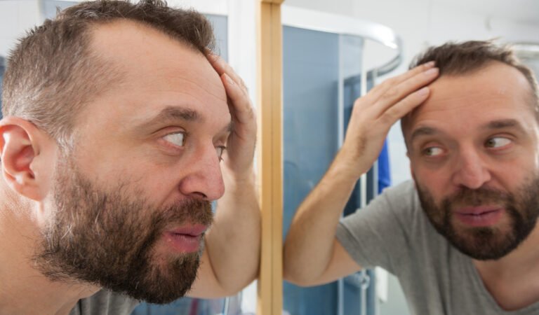 탈모와 낮은 자존감 사이의 연관성 (해결 방법) •